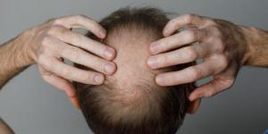 أمل جديد للرجال.. علاج ثوري يحقق قفزة غير مسبوقة في استعادة الشعر المفقود - وضوح نيوز
