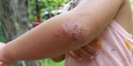 آلية جزيئية جديدة تكشف دور استقلاب الدهون في تفاقم مرض الصدفية - وضوح نيوز