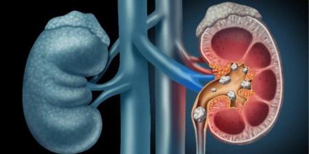 تطوير أول أداة مدعومة بالذكاء الاصطناعي للكشف المبكر عن سرطان الكلى - وضوح نيوز