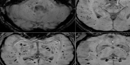 دراسة بالرنين المغناطيسي تكشف تأثيرات طويلة الأمد لكوفيد-19 على الدماغ - وضوح نيوز