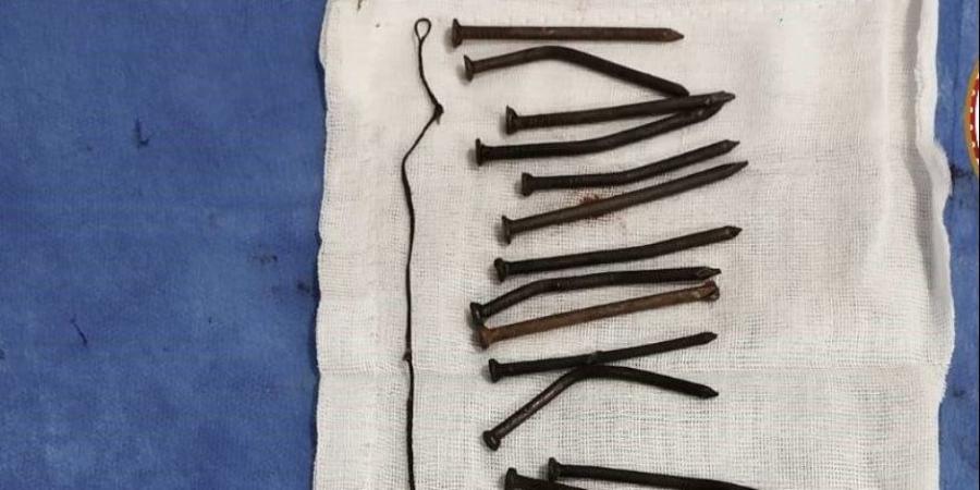 تفاصيل إنقاذ سيدة ابتلعت 34 مسمارًا منذ 45 يوما في كفر الشيخ - وضوح نيوز