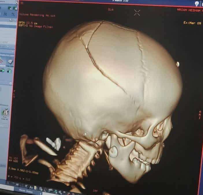 نفذت أول رواية مروعة تتعلق بمحاولة والدة الطفلة المصابة في التواهي